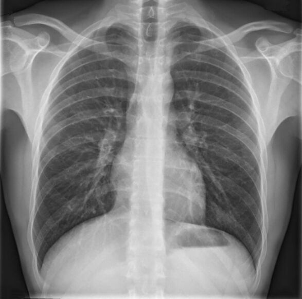 Osteochondrosis of the chest is diagnosed using radiography