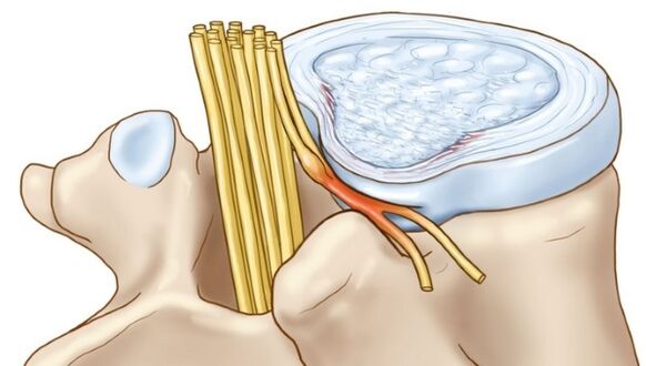 The protrusions of the intervertebral disc, which appear in thoracic osteochondrosis, press the nerve endings