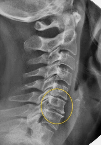 Osteochondrosis of the cervical spine on x -ray