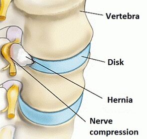 Osteochondrosis of the cervical region