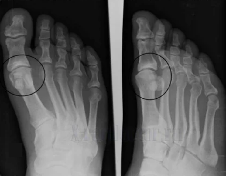 Diagnosis of arthrosis