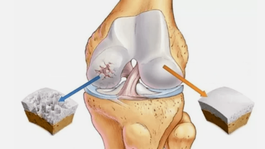 How does arthrosis develop