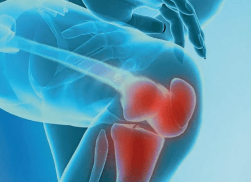 What is arthrosis
