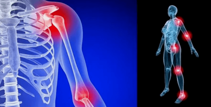deformation of the limbs for arthrosis