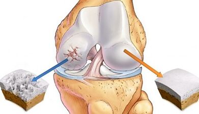 causes of arthrosis of the joints