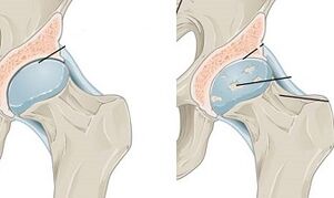 stages of development of hip osteoarthritis