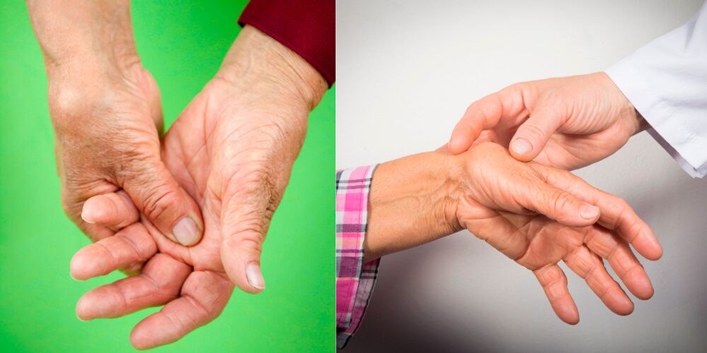 Swelling and aching pains are the first signs of arthritis of the hands